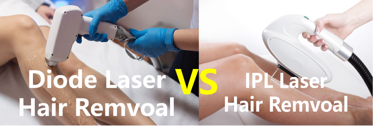 IPL VS DIOD LASER PENANGGULANGAN RAMBUT