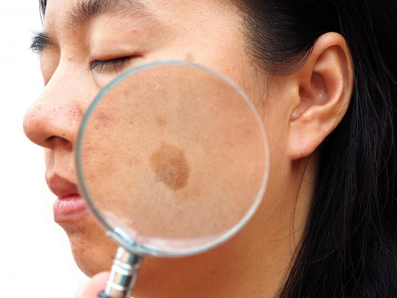 Picosecond Laser: penolong yang baik untuk menghilangkan melasma