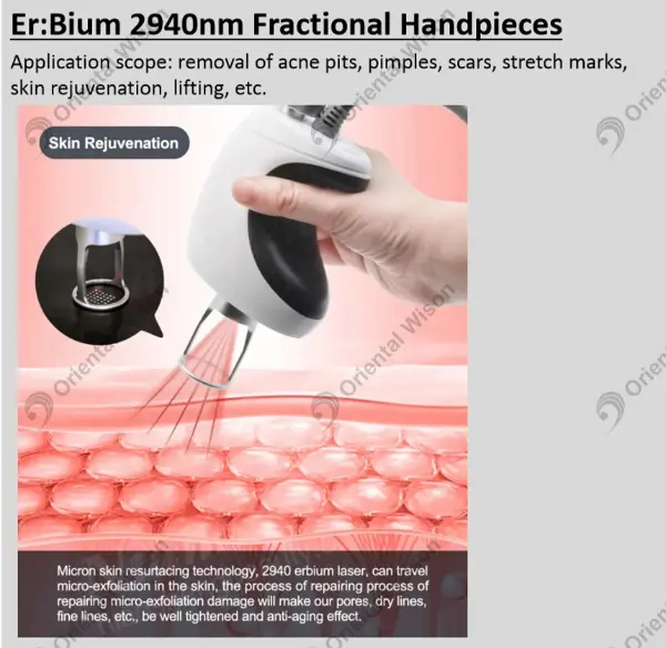 Pakar Pembaharuan Kulit Baharu- Laser Erbium 2940nm