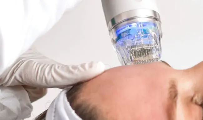 Apakah faedah rawatan jarum mikro RF?