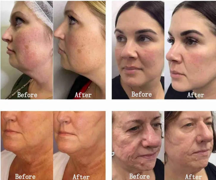 M8 Microneedle Rf Machine